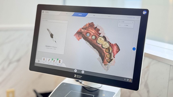 高精度カメラによる口腔内スキャン