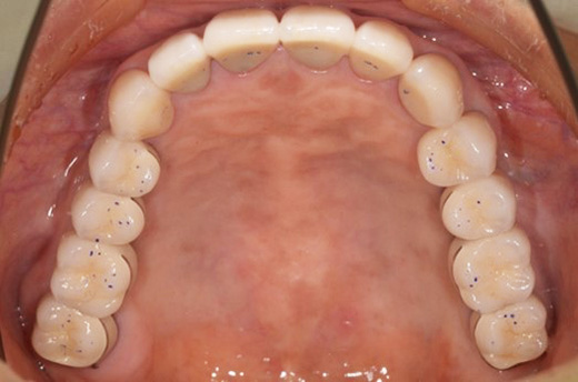 フルマウス治療を行った実際の症例をもとにした参考イメージ