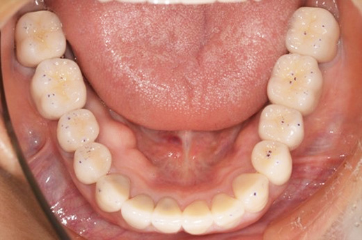 フルマウス治療を行った実際の症例をもとにした参考イメージ