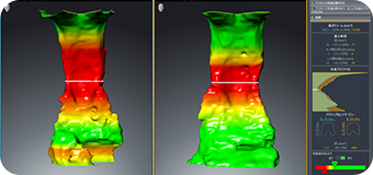 SICAT-Airによる気道容積の可視化（睡眠時無呼吸症候群）