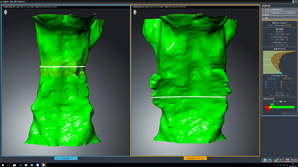 マウスピース型治療症例の前後比較